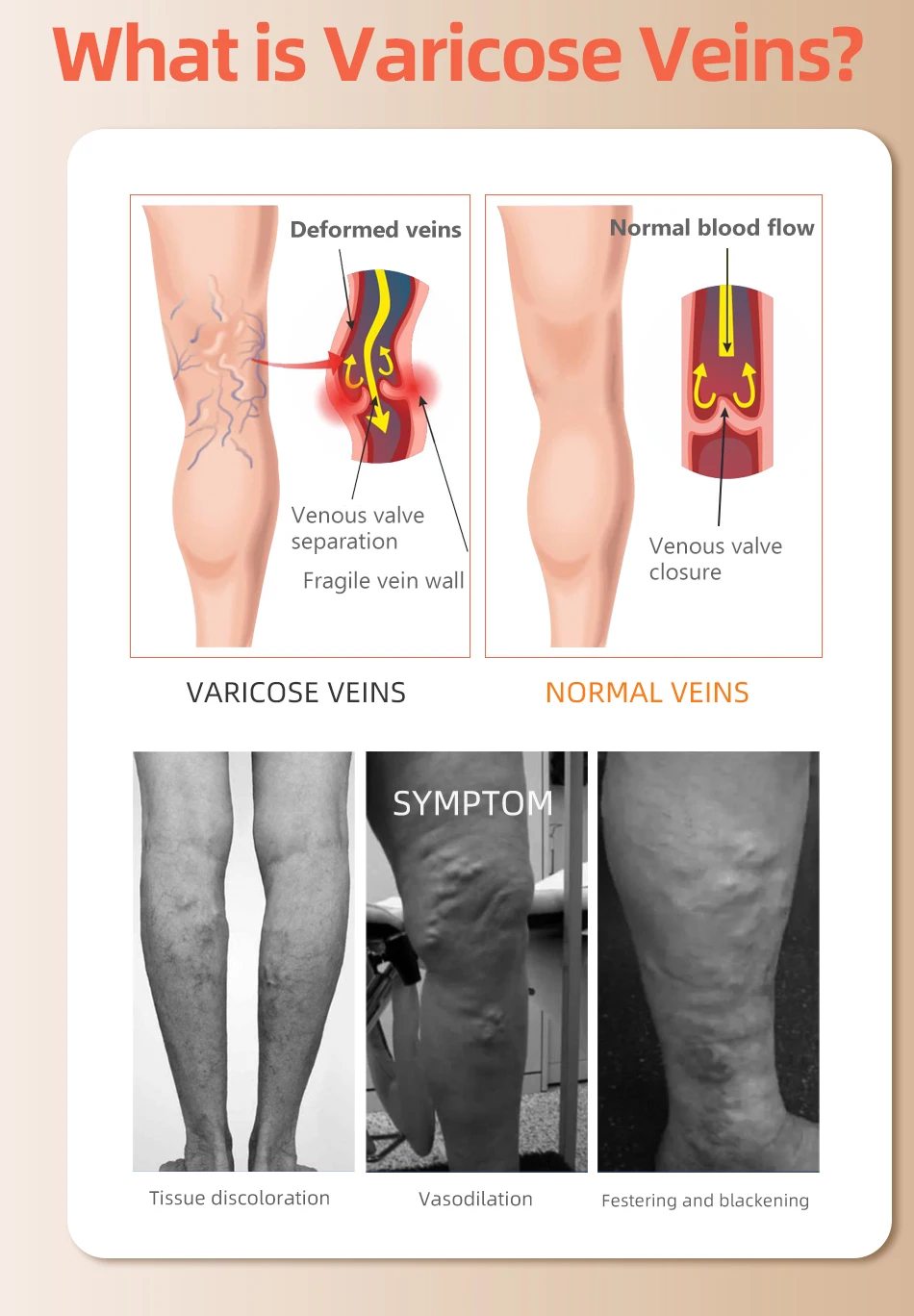 30-40 MmHg Over Knee Closed To - Compression Sock Medical 评论和价格
